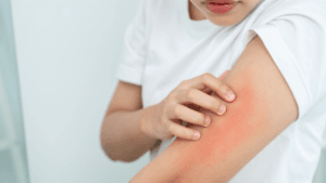 Skin Picking — quando o ato de cutucar a pele se torna um transtorno
