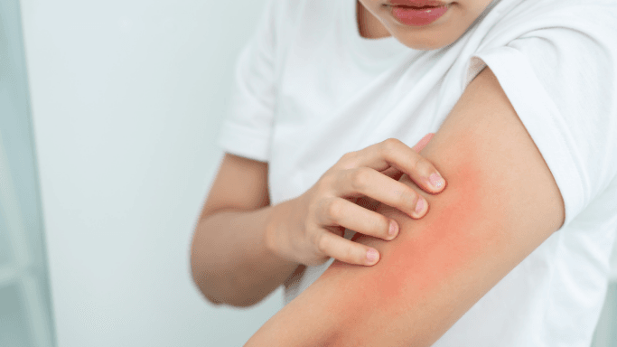 Skin Picking — quando o ato de cutucar a pele se torna um transtorno